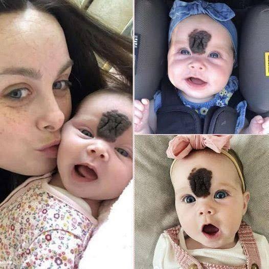A Mother’s Inspiring Journey to Help Her Daughter Overcome Her Birthmark