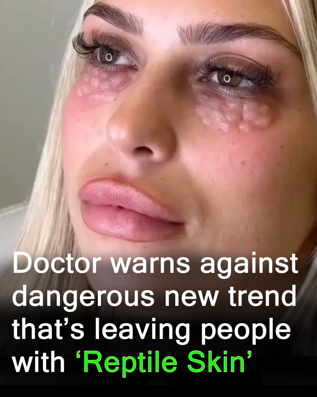 Doctors warn against beauty trend that causes reptile skin