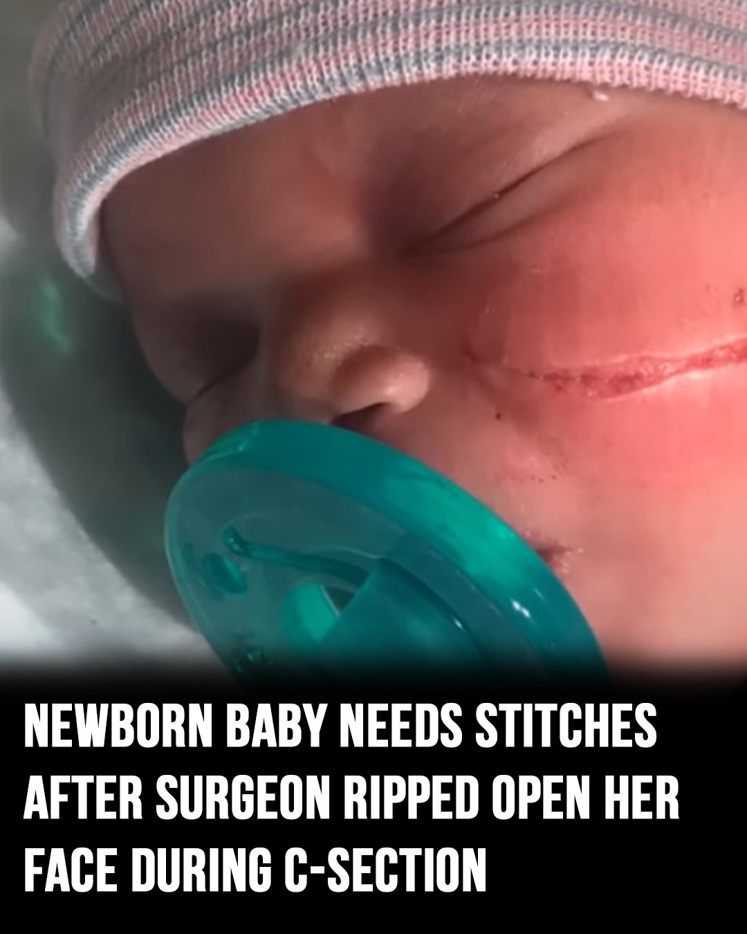 Newborn baby needs 13 stitches after surgeon ripped open her face during C-section