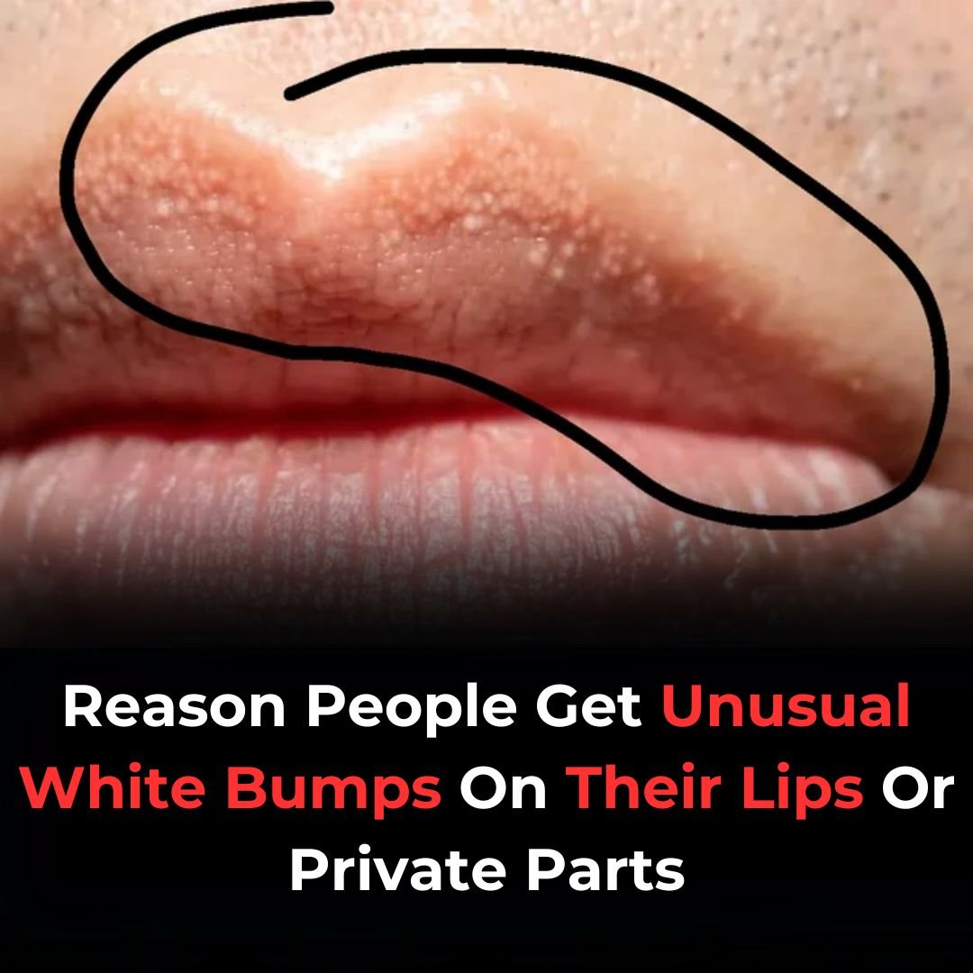 Why You Might See Unusual White Bumps On Your Lips Or Genitals