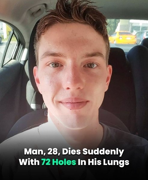 Man, 28, Dies Suddenly With 72 Holes In His Lungs