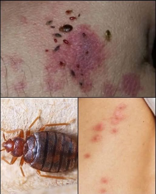 Bedbug: Easy Ways to Get Rid of Them at Home
