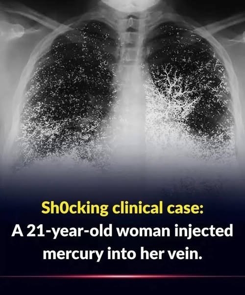 Sh0cking clinical case: 21-year-old woman injected mercury into a vein.