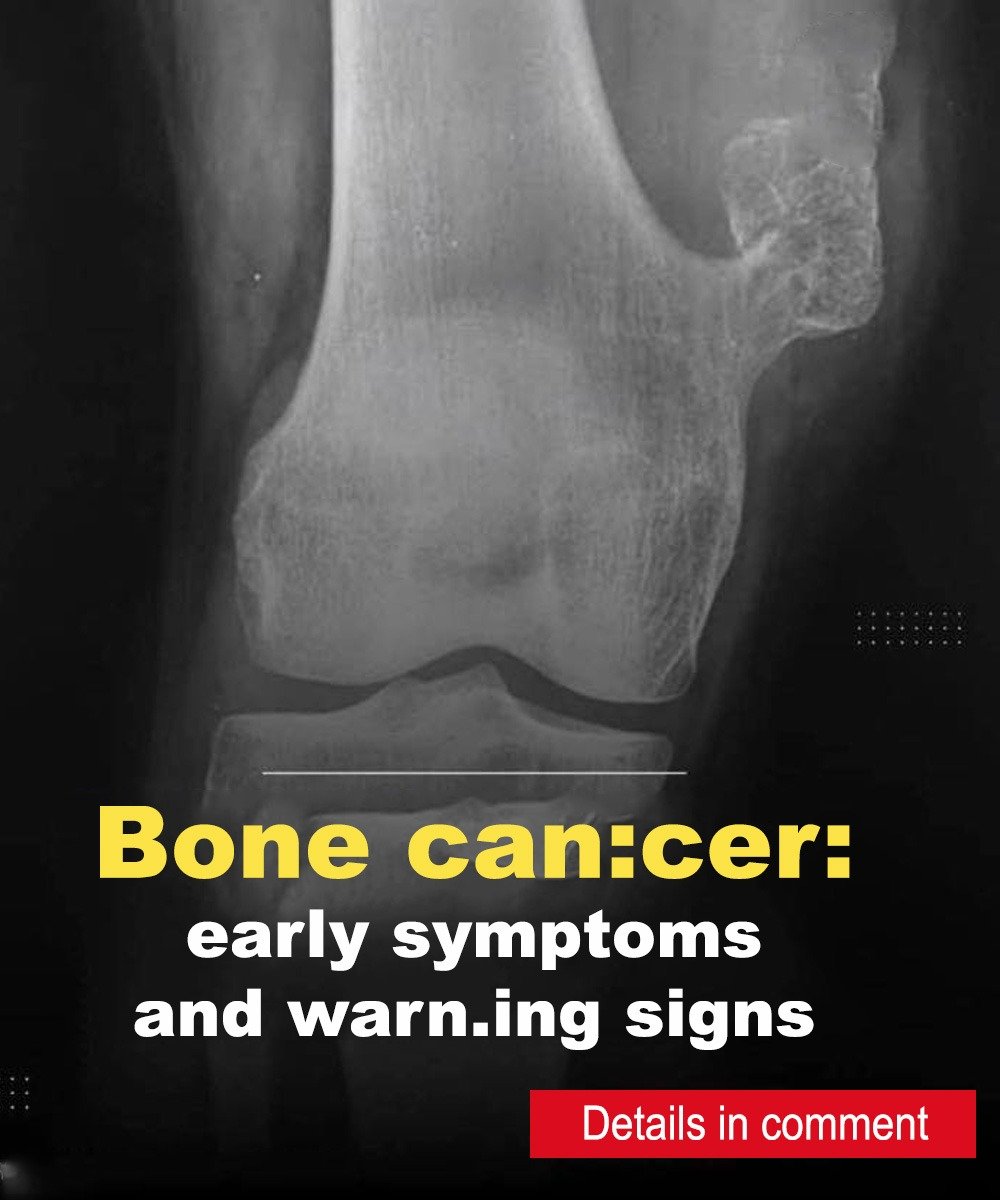 Bone can.cer: early signs you shouldn’t ignore