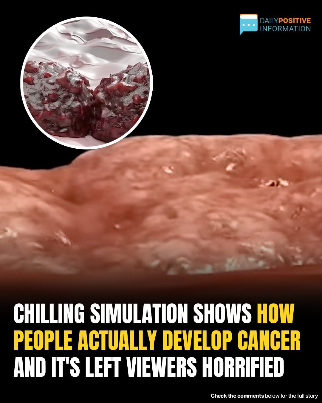 Chilling Simulation Shows How Cancer Takes Over The Body—Viewers Horrified