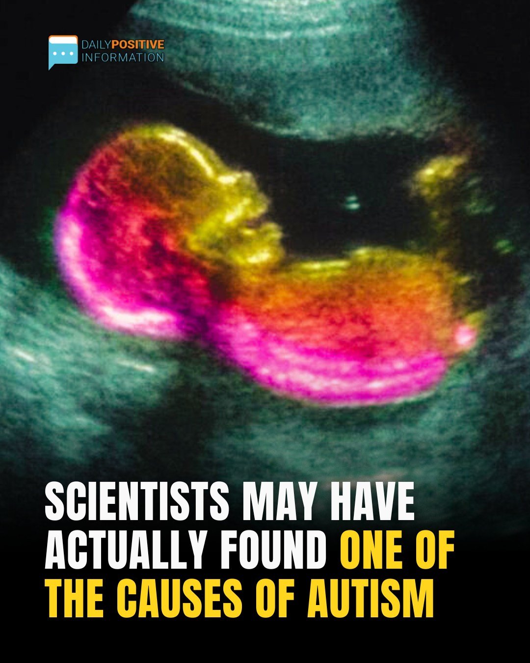 Study Suggests Key Link That Could Help Explain Autism Development