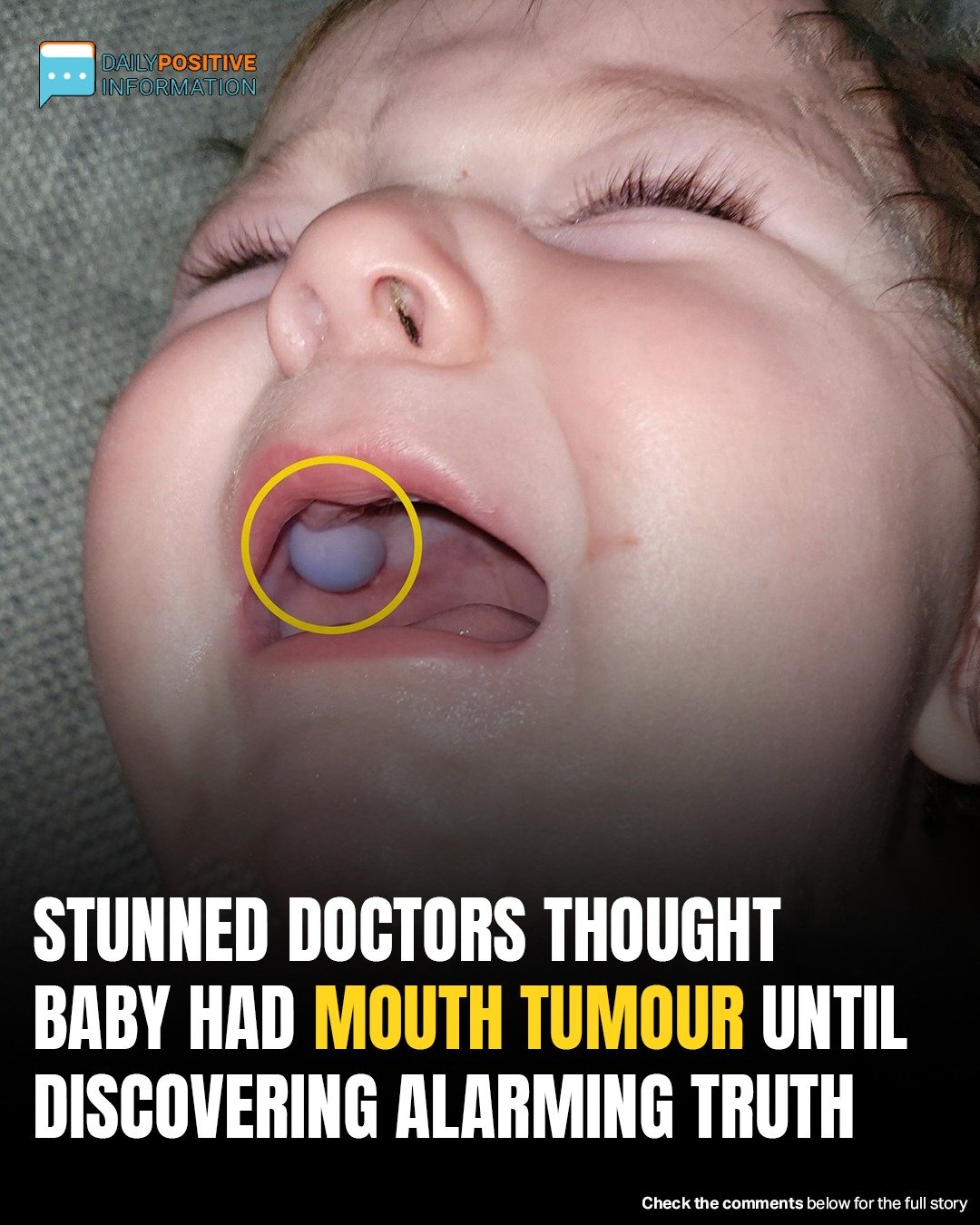 Doctors Suspected Baby Had Mouth Tumor—The Shocking Truth Left Them Speechless