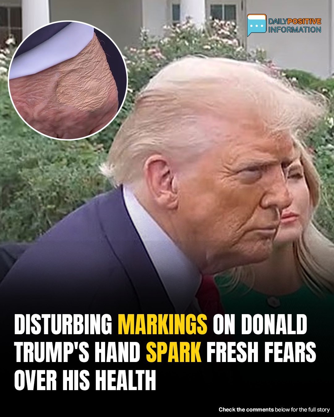 Concerning Marks On Trump’s Hand? Experts Reveal What They Really Are