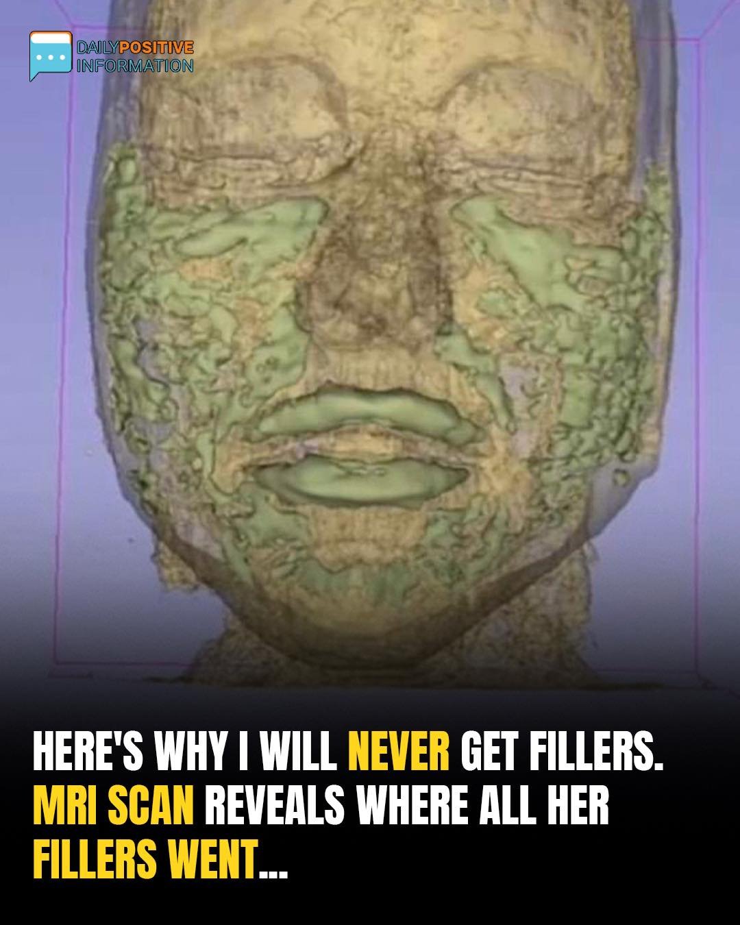 Doctor Reveals: MRI Scan Of The Face Of A 33-Year-Old Woman Reveals Where All Of Her Filler Went