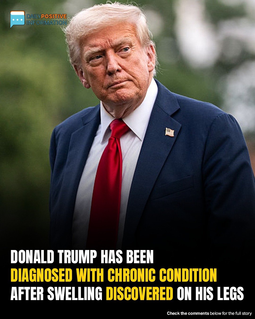 Trump Diagnosed With Vein Condition After Swollen Legs Spark Concern