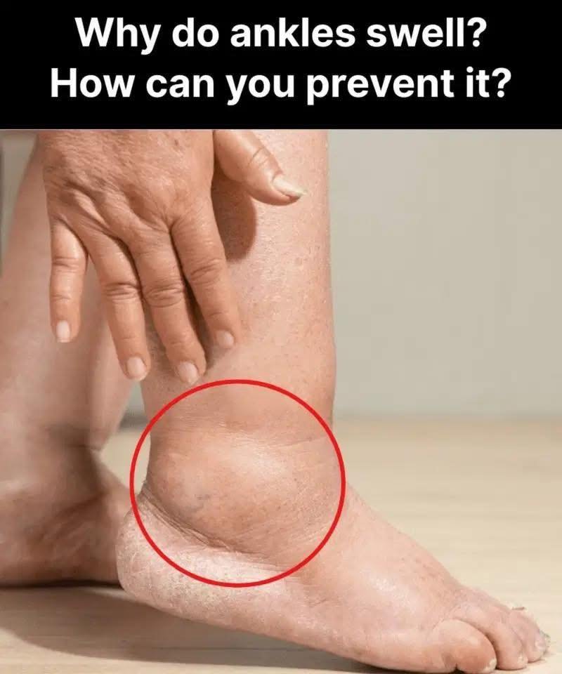 Why do ankles swell? How can you prevent it?