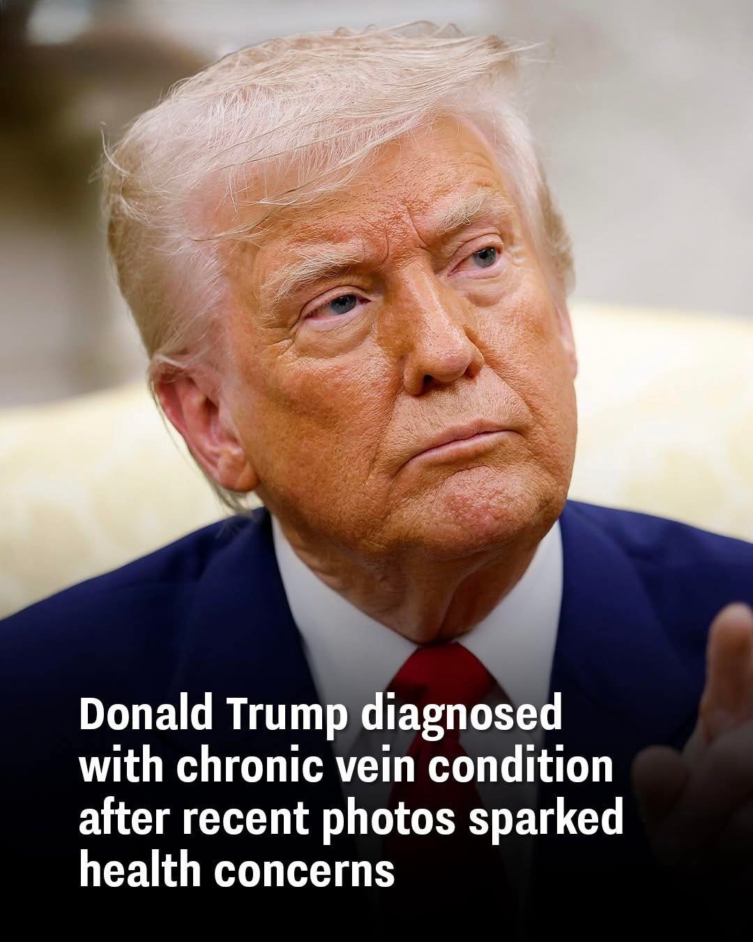 President Trump Diagnosed with Chronic Venous Condition, Health Officials Confirm