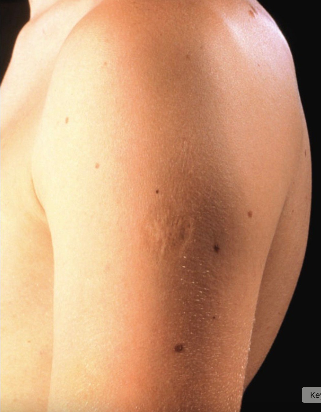 Smallpox vaccine scars: What they look like and why