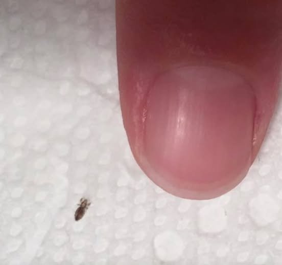 If you find this bug in your hair. How to get rid of them and stop them coming back