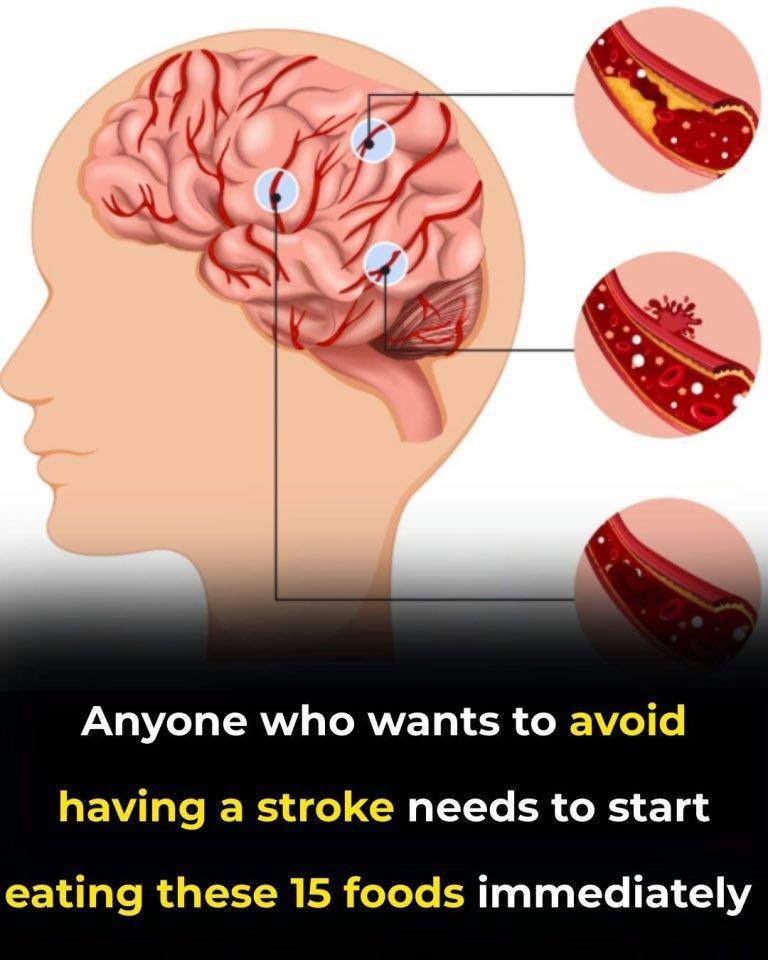 Anyone who wants to prevent a stroke needs to start eating these 15 foods immediately