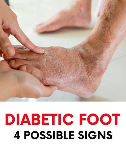 Diabetic foot: what it is and how to treat one of the most serious complications of diabetes