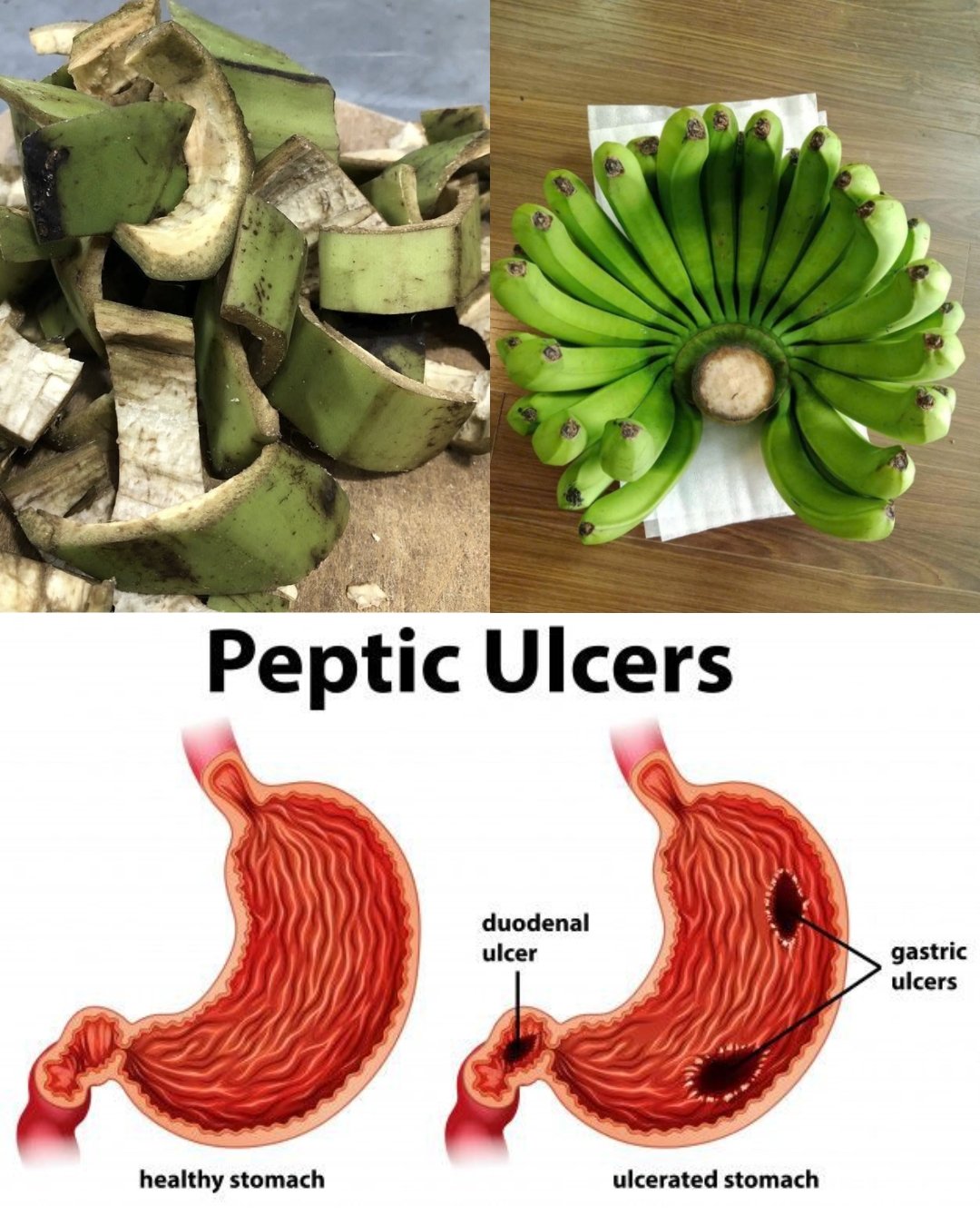 Natural Remedies for Stomach Ulcers & H. pylori: Plantain Peel Treatment