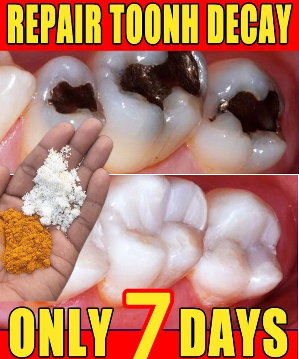 100% Natural Home Remedy for Tooth Decay, Yellow Teeth, and Tooth Pain
