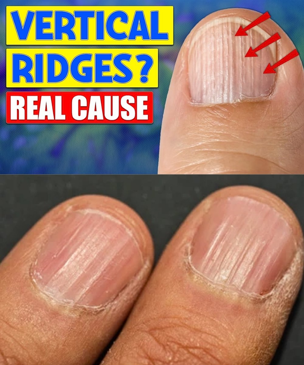 The REAL Causes of Vertical Ridges on Your Nails